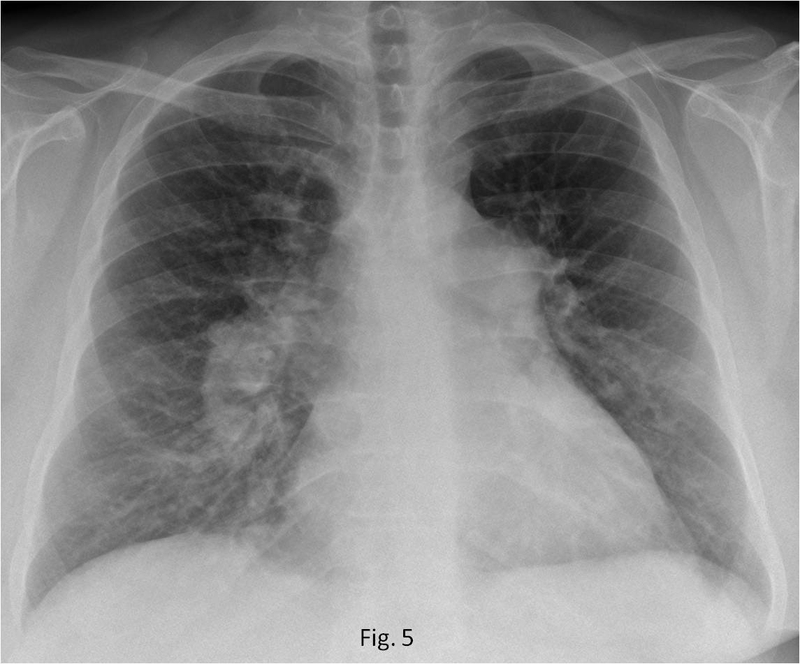 Tăng áp phổi sống được bao lâu và người bệnh cần làm gì để kéo dài tuổi thọ? - 1