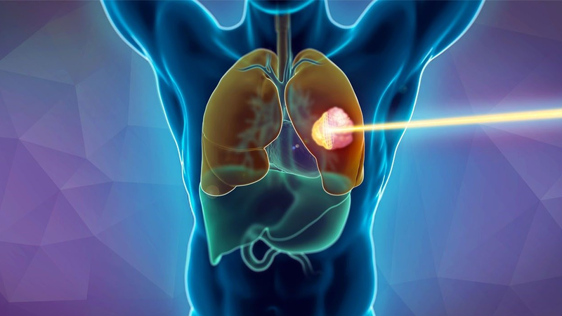 Tăng áp phổi sống được bao lâu và người bệnh cần làm gì để kéo dài tuổi thọ? - 3