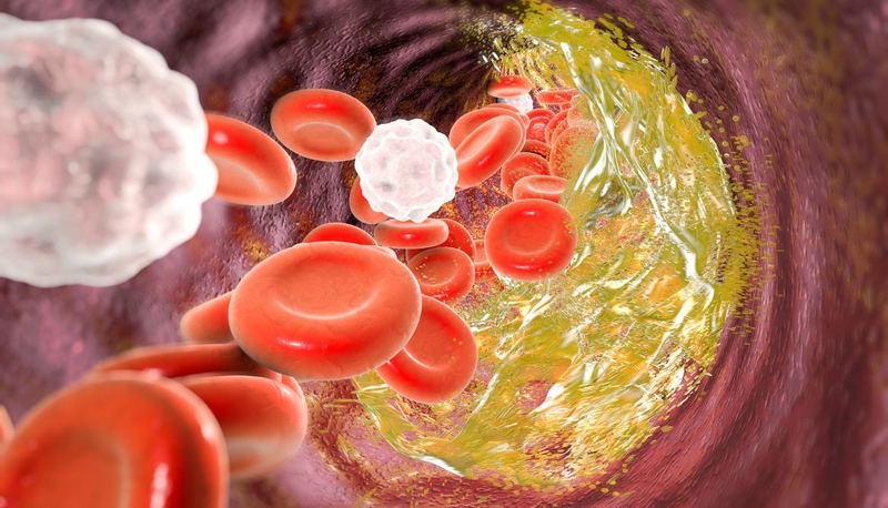 Tăng cholesterol máu gia đình: Nguyên nhân, triệu chứng, cách điều trị 1