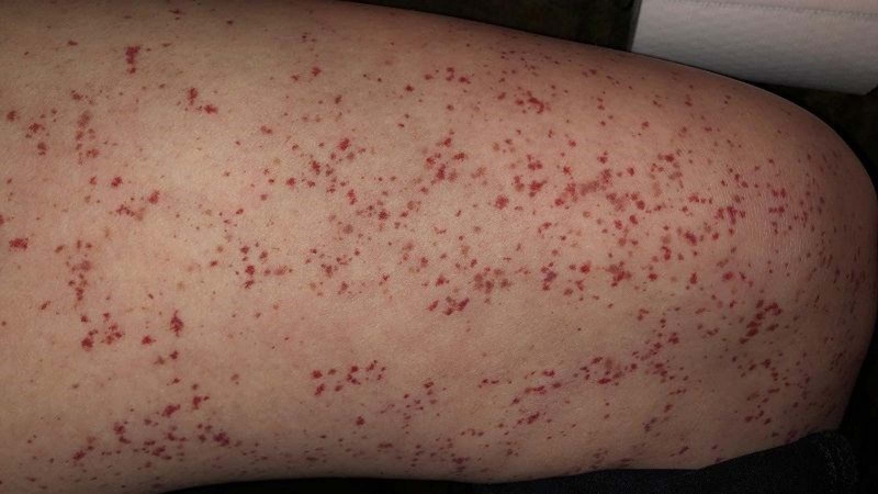 Tăng đông máu là gì? Nguyên nhân và điều trị 3