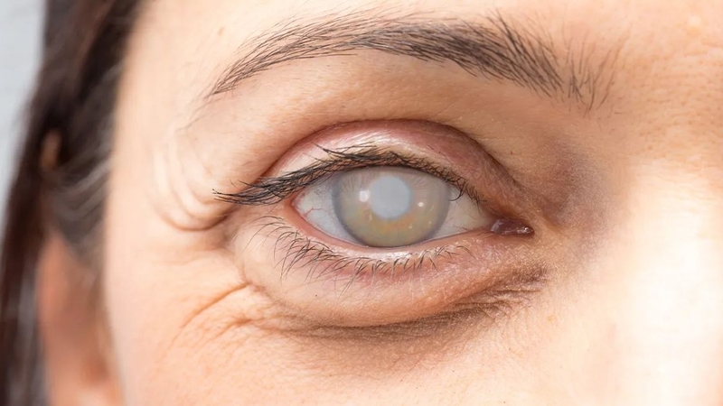 Tăng huyết áp mắt: Nguyên nhân và cách điều trị 2