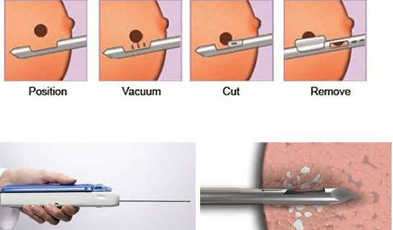 Sinh thiết mô tuyến vú