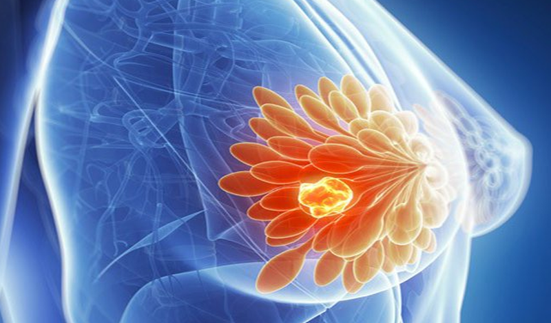 Tăng sản xơ cứng tuyến vú dễ nhầm lẫn với khu u ung thư vú