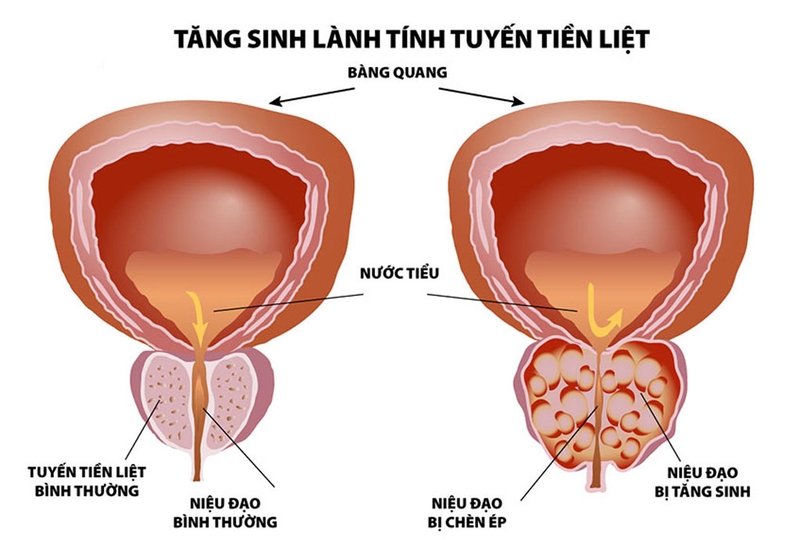 Tăng sinh lành tính tuyến tiền liệt là gì?