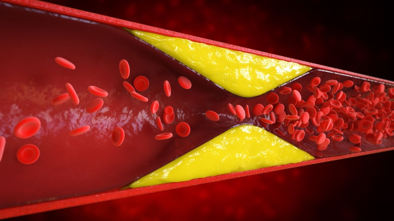 Tăng Triglyceride máu nặng: Nguyên nhân, chẩn đoán và phương pháp điều trị 2