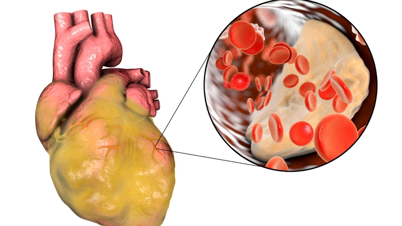 Tăng Triglyceride máu nặng: Nguyên nhân, chẩn đoán và phương pháp điều trị 3