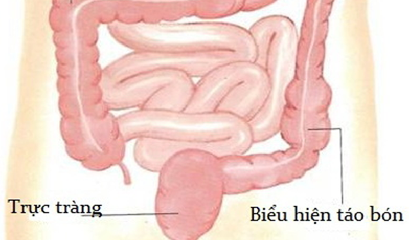 Kích thích nhu động ruột giúp đi tiêu dễ dàng hơn, giảm táo bón