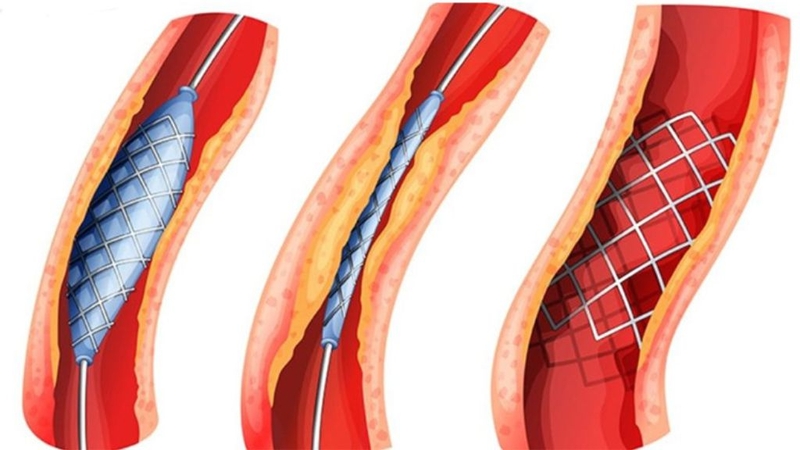 Tạo hình niệu quản: Thông tin từ A đến Z về bệnh! 1