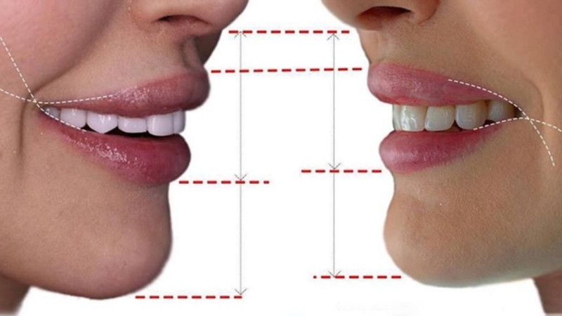 Tạo khoé miệng cười: Quy trình phẫu thuật, cách chăm sóc 4