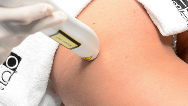 Tập gym bị rạn da có đáng lo không? Khắc phục như thế nào? 4