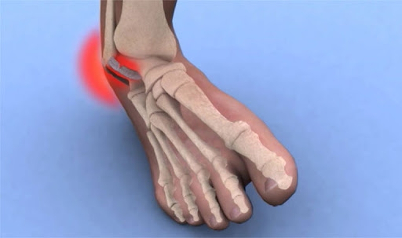 Những Cách Xử Lý Và Bài tập phục hồi bong gân cổ chân 1