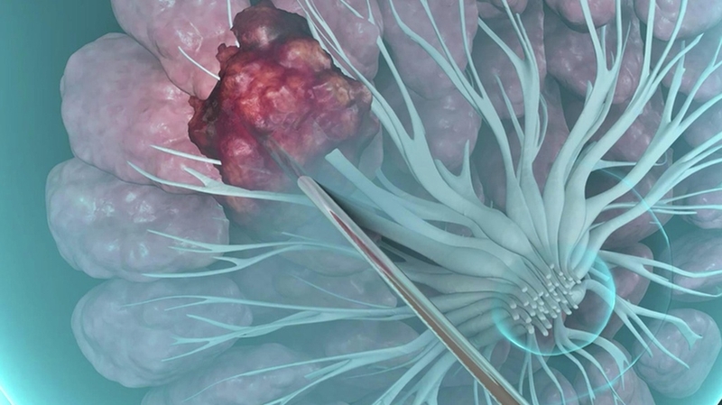 Tất cả những điều bạn cần biết về sinh thiết vú 2