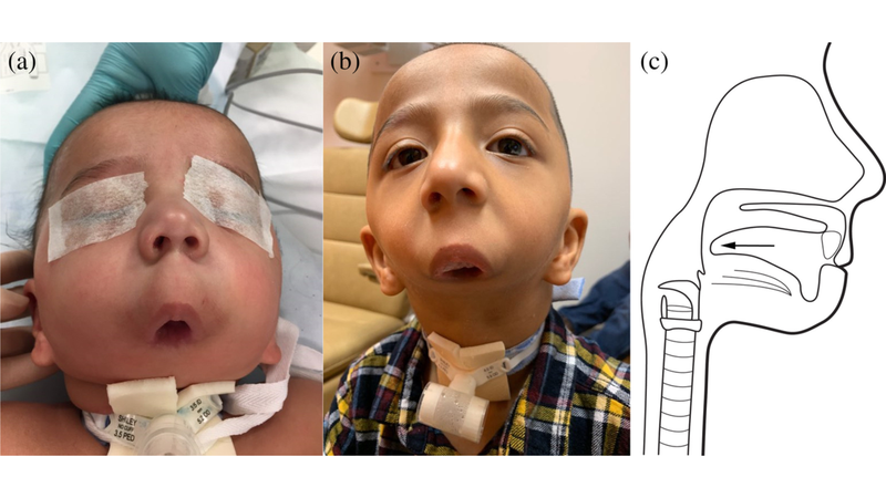 tat-khong-co-ham-nguyen-nhan-trieu-chung-va-huong-dieu-tri 2.png