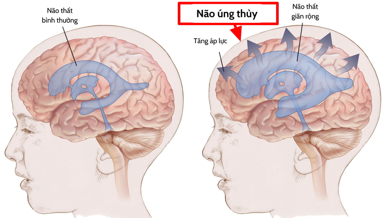 Tật nứt đốt sống: Nguyên nhân, chẩn đoán và điều trị 4