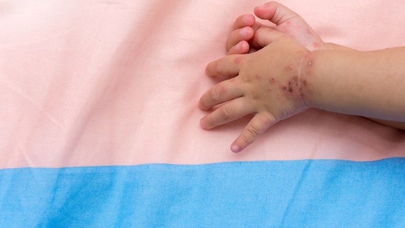 Tất tần tật những điều cần biết về bệnh tay chân miệng ở trẻ sơ sinh 7