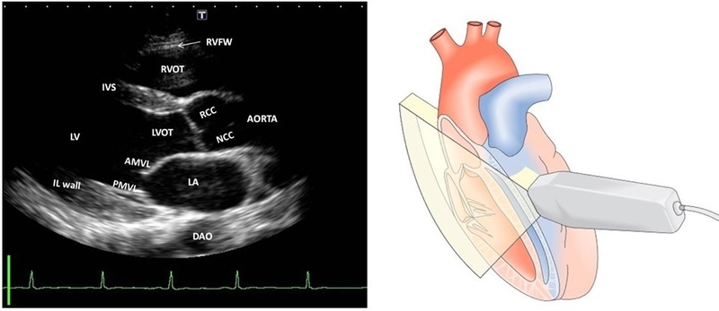 Tất tần tật về các mặt cắt cơ bản trong siêu âm tim 2