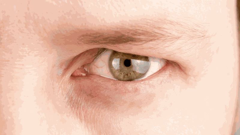 Tất tần tật về cắt mí mắt bị sụp: Có nên phẫu thuật mí mắt bị sụp không? 1