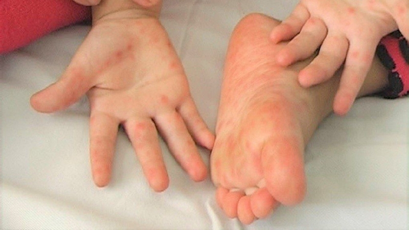 Tay chân miệng cách ly bao lâu tùy theo tình trạng bệnh và tốc độ hồi phục của mỗi trẻ