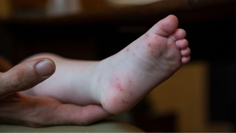 Tay chân miệng độ 4 là mức độ nặng nhất của bệnh tay chân miệng ở trẻ nhỏ