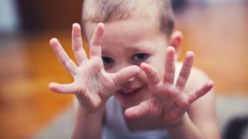 Tổn thương da nặng với bọng nước, vết loét, lan rộng mặt, tay chân, môi, da đầu