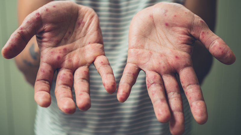 Tay chân miệng lây qua đường nào? Cách phòng tránh bệnh tay chân miệng 1