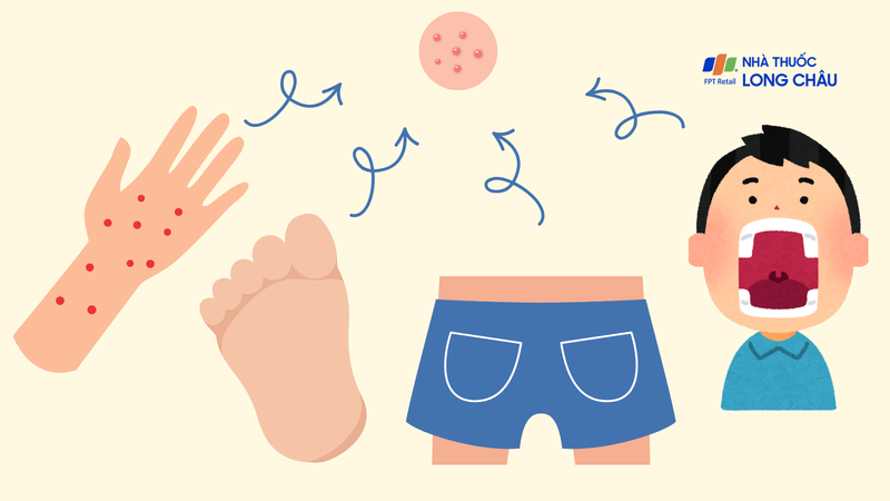 Những vị trí thường gặp ở trẻ mắc tay chân miệng nổi ở mông