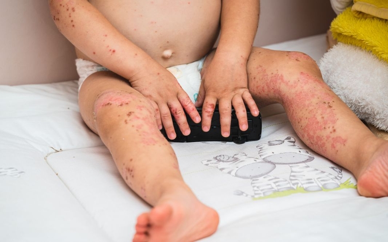 Bệnh tay chân miệng người lớn: Nguy hiểm hơn chúng ta vẫn nghĩ 1