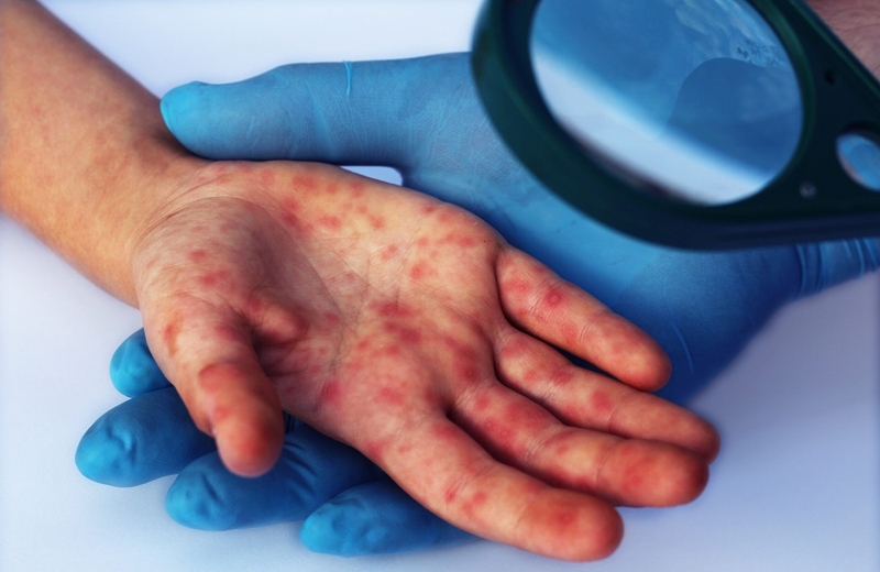 Bệnh tay chân miệng người lớn: Nguy hiểm hơn chúng ta vẫn nghĩ 4