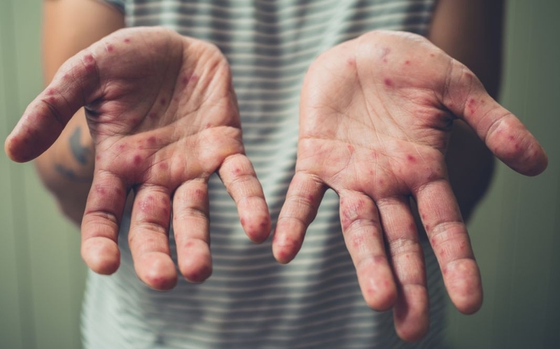 Bệnh tay chân miệng người lớn: Nguy hiểm hơn chúng ta vẫn nghĩ 2