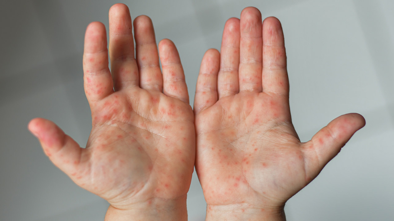 Thời gian gần đây, số ca mắc bệnh truyền nhiễm ở trẻ nhỏ đang có dấu hiệu gia tăng tại nhiều địa phương