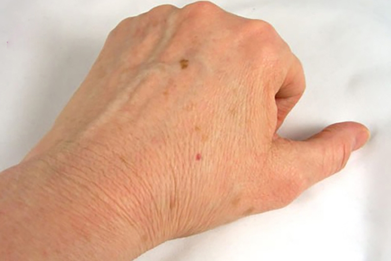 Tay nổi đốm nâu như đồi mồi có nguy hiểm không?