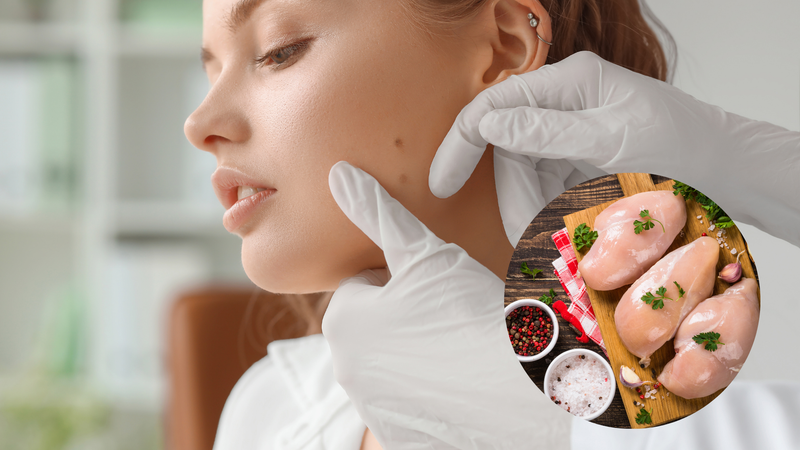 Tẩy nốt ruồi ăn thịt gà có sao không 2