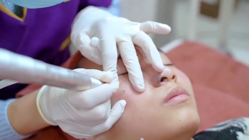 Tẩy nốt ruồi bằng laser có hiệu quả và an toàn không? Lưu ý sau điều trị 1