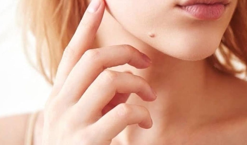 Tẩy nốt ruồi bằng laser có hiệu quả và an toàn không? Lưu ý sau điều trị 2