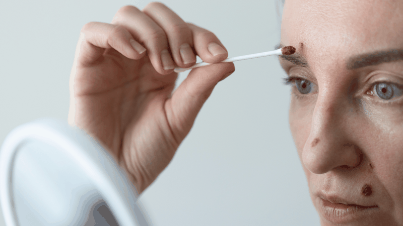 Tẩy nốt ruồi bao lâu thì hết thâm?