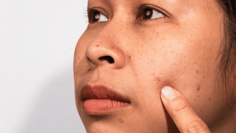 Những người da sẫm màu, da dầu hoặc dễ tăng sắc tố sau viêm có nguy cơ bị thâm kéo dài do melanin tăng sinh mạnh