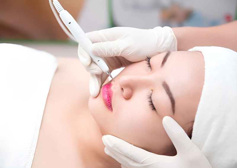 Tẩy nốt ruồi bao nhiêu tiền? Cách chăm sóc da chuẩn y khoa sau khi tẩy nốt ruồi 1