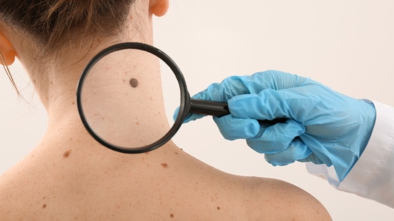 Tẩy nốt ruồi có được ăn xúc xích không? Lời khuyên bác sĩ khi tẩy nốt ruồi 1