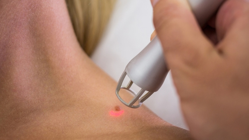 Tẩy nốt ruồi có được ăn xúc xích không? Lời khuyên bác sĩ khi tẩy nốt ruồi 3