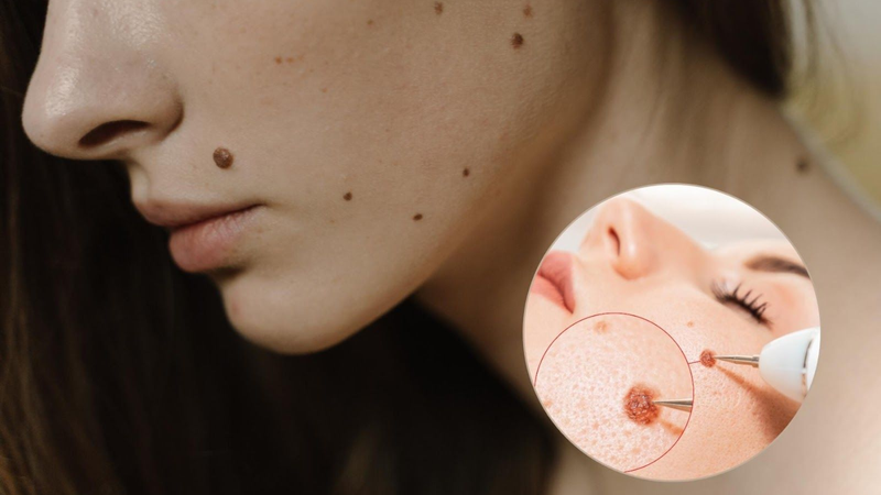 tẩy nốt ruồi có mọc lại không 2