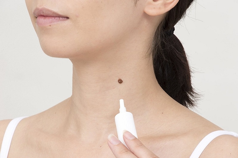 Tẩy nốt ruồi kiêng gì để da nhanh chóng hồi phục 3