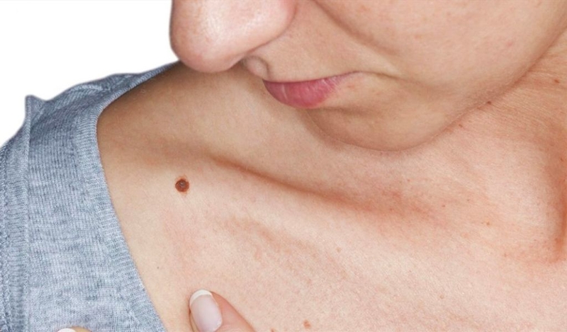 Tẩy nốt ruồi to và lồi có an toàn không? Cách khắc phục phổ biến? 1