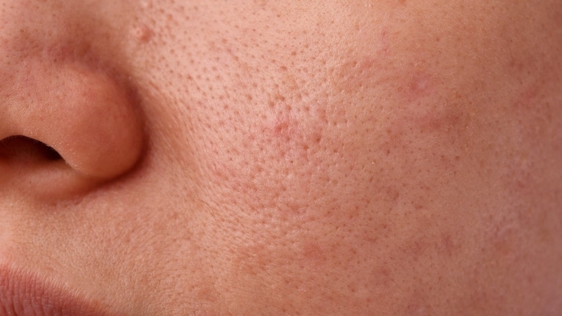 Dầu em bé làm sạch không kỹ có thể tăng nguy cơ bít tắc lỗ chân lông