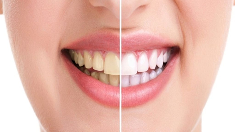 Tẩy trắng là gì? Bảo vệ răng miệng thế nào sau tẩy trắng?  1
