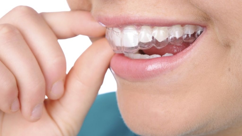 Tẩy trắng là gì? Bảo vệ răng miệng thế nào sau tẩy trắng? 2