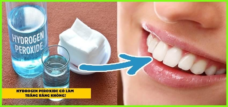 Tẩy trắng răng bằng cách sử dụng trực tiếp hydrogen peroxide thấm lên tăm bông