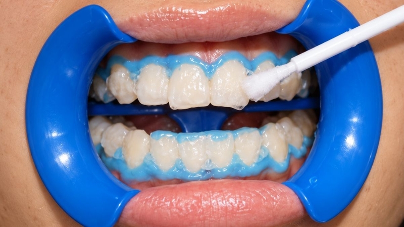 Tẩy trắng răng bị bỏng nướu do nồng độ thuốc tẩy trắng quá cao