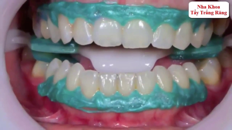 Quá trình tẩy trắng răng: sử dụng thuốc tẩy trắng thoa lên răng kết hợp với đèn chiếu laser