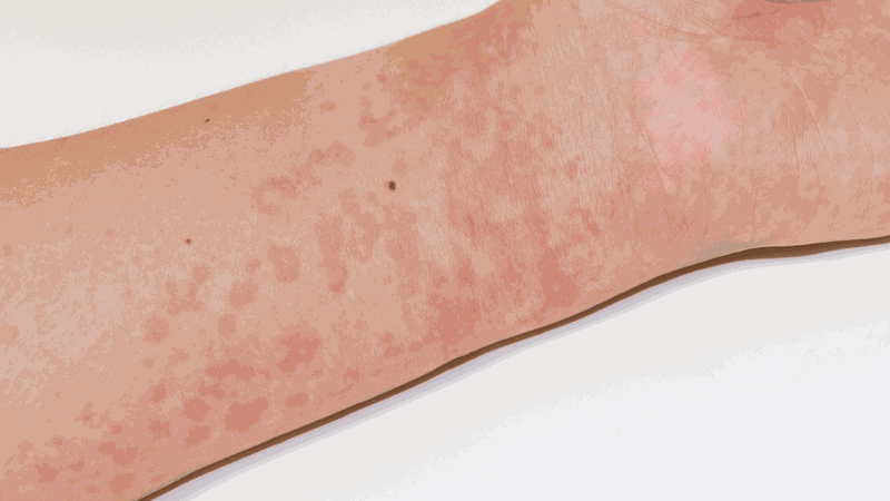 TB test là gì? Những thông tin cần biết 4