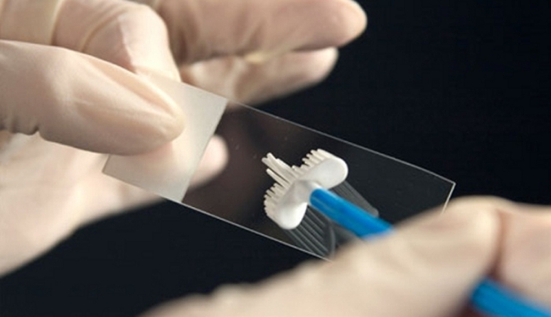 Tế bào ascus có nguy hiểm không? Làm gì khi xét nghiệm Pap có tế bào ascus? 3